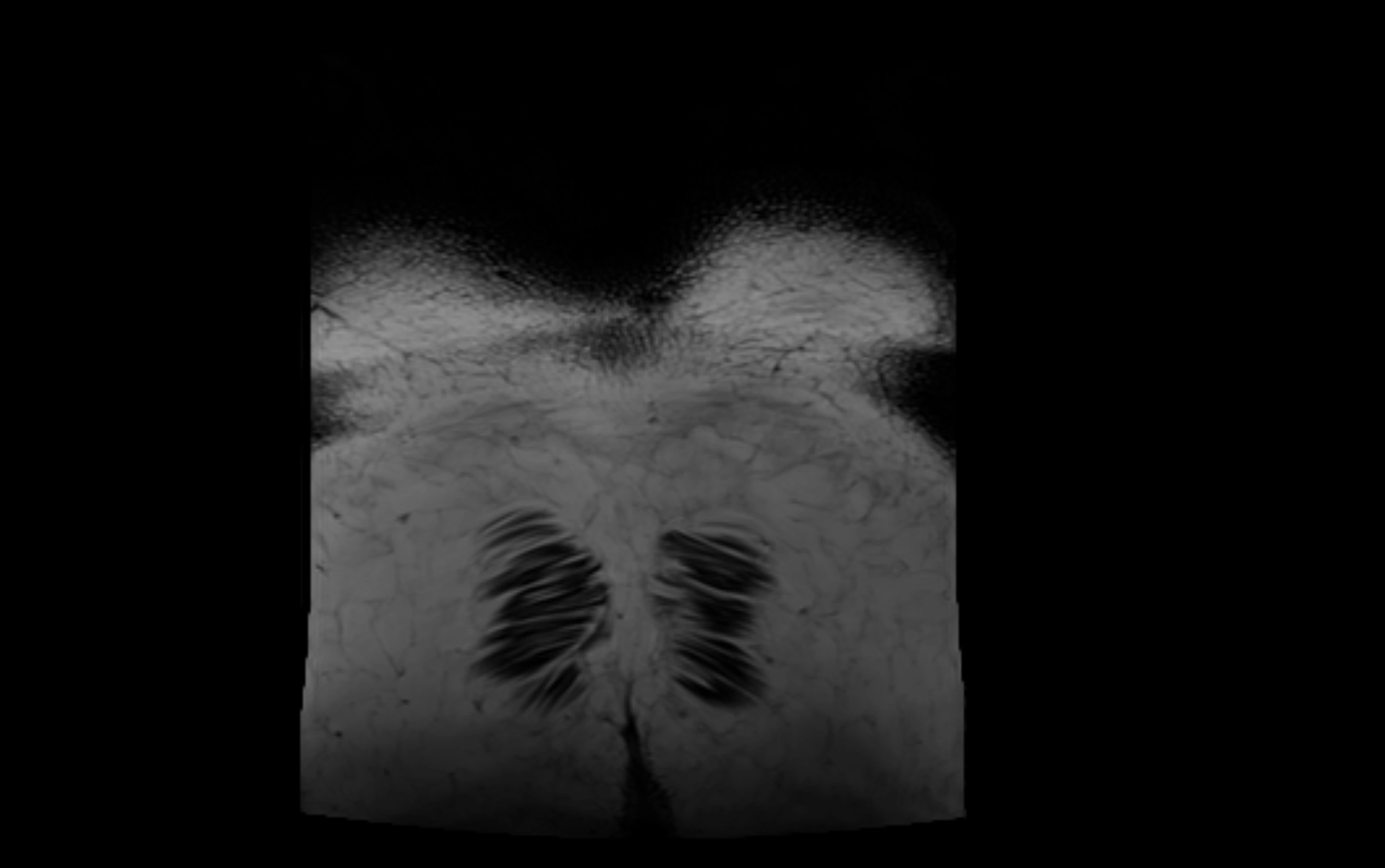 MR lumbosacral plexus cross sectional anatomy 3T  radiology  image-img-09001-00093.webp